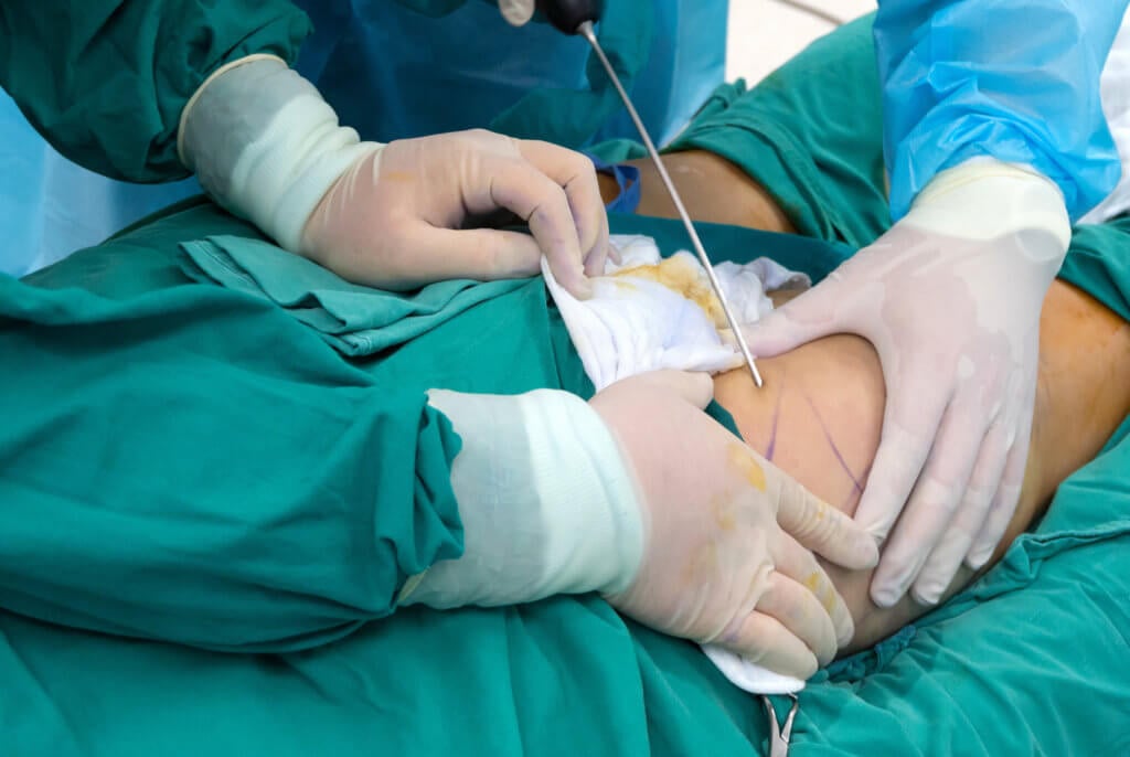 Vaser Lipo: Ultrasound-Assisted Liposuction Explained